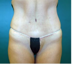 Abdominoplasty 0240 After