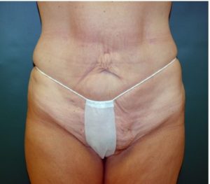 Abdominoplasty 0240 Before