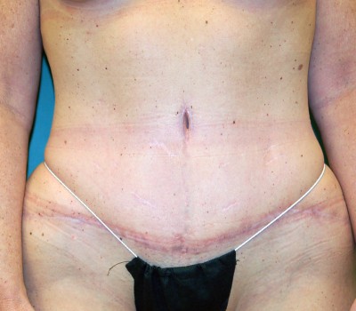 Abdominoplasty Front 0607 After