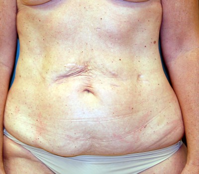 Abdominoplasty Front 0607 Before