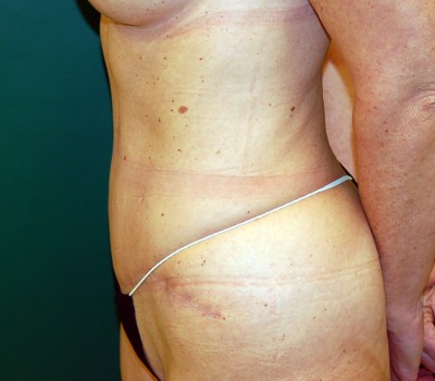 Abdominoplasty Side 0607 After