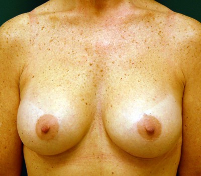 breast augmentation front after