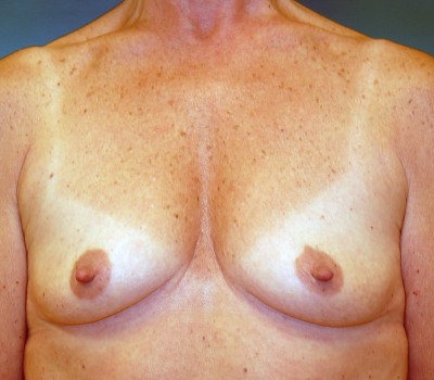 breast augmentation front before