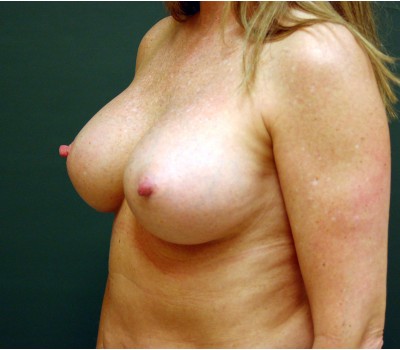 breast augmentation oblique
