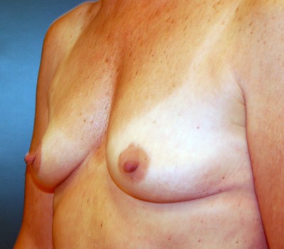 breast augmentation oblique before