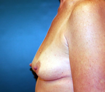 Breast Augmentation Side 0593 Before