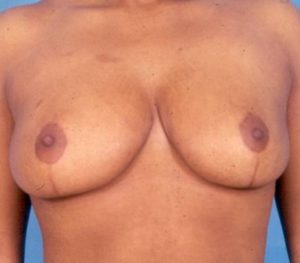 Abdominoplasty 0240 After