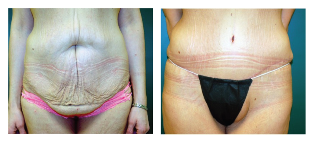 Abdominoplasty