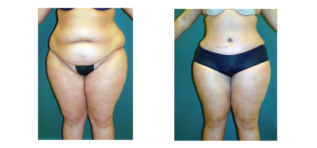 Before & After Abdominoplasty