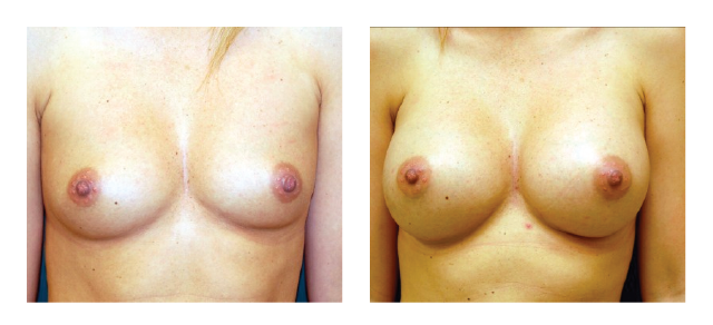 breast augmentation