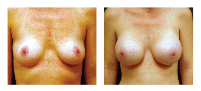 Breast Augmentation