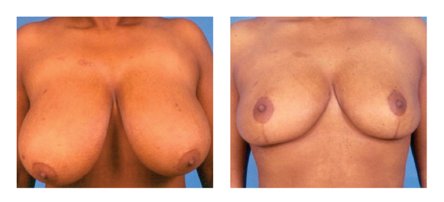 Breast Reduction