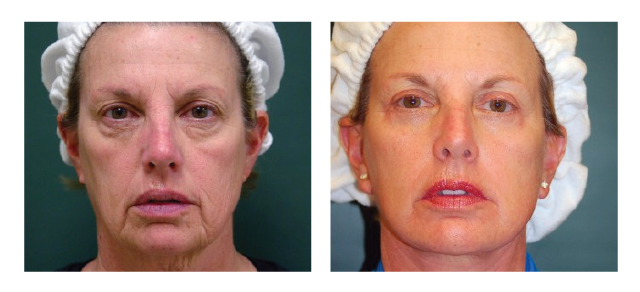 Face & Necklift