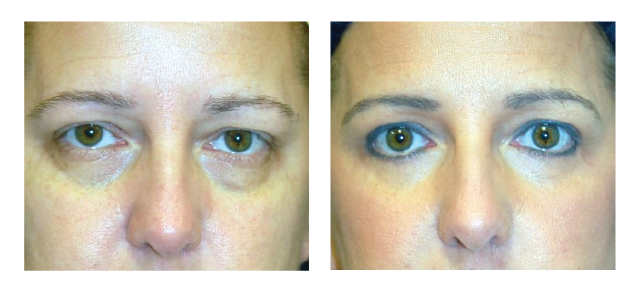 Lower Blepharoplasty