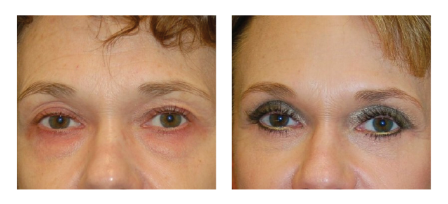 Upper and Lower Blepharoplasty