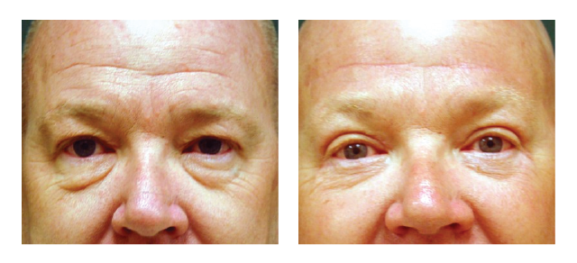 Upper and Lower Eyelids