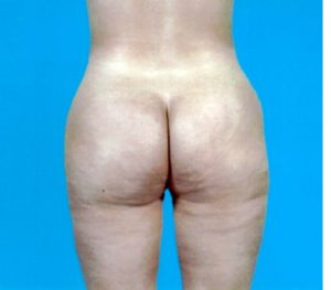 Abdominoplasty 0240 After