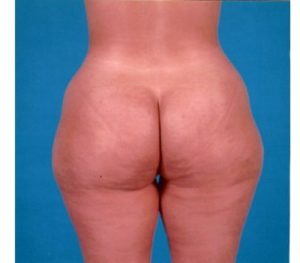 Abdominoplasty 0240 Before