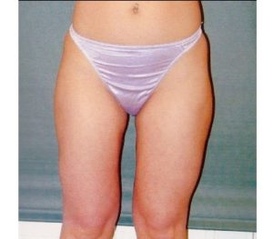 Abdominoplasty 0240 After