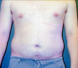 Abdominoplasty 0240 Before