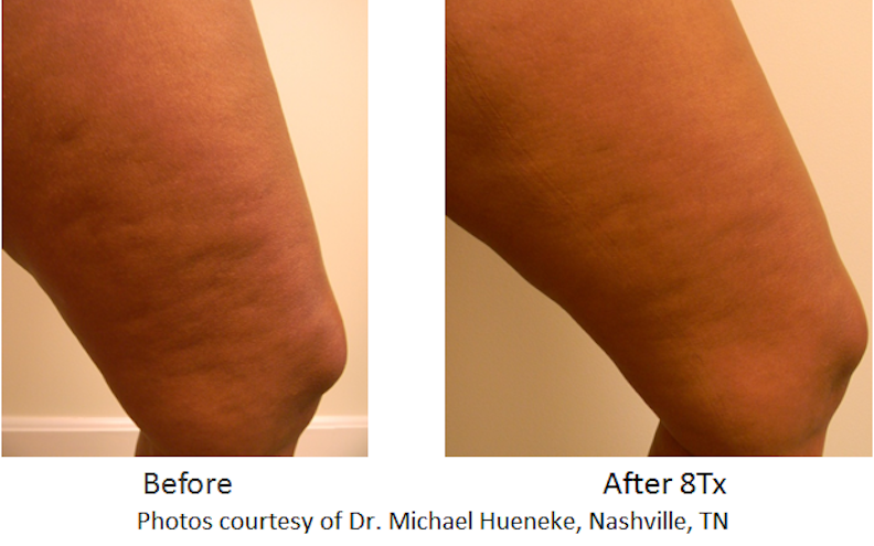 Cellulite Reduction