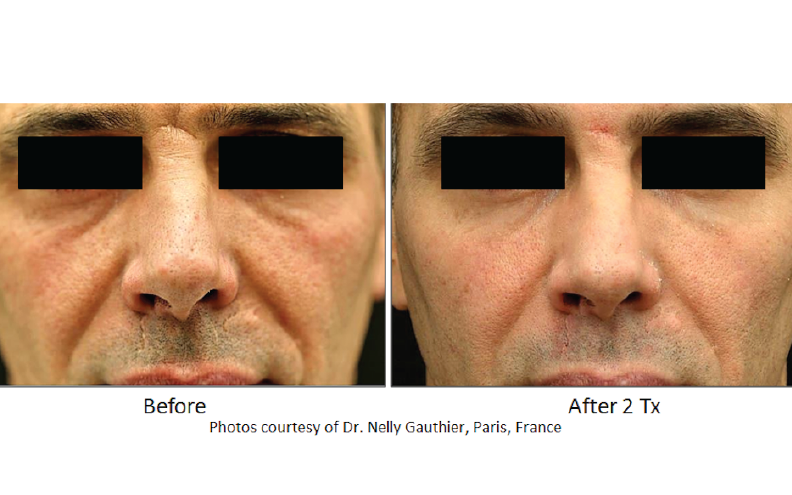 Fractional Laser Resurfacing