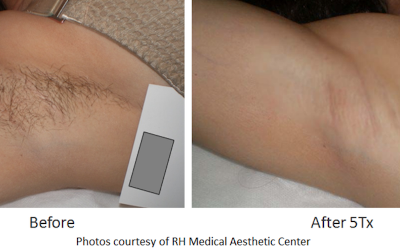 Laser Hair Removal - Face & Body - Plastic Surgery Specialists