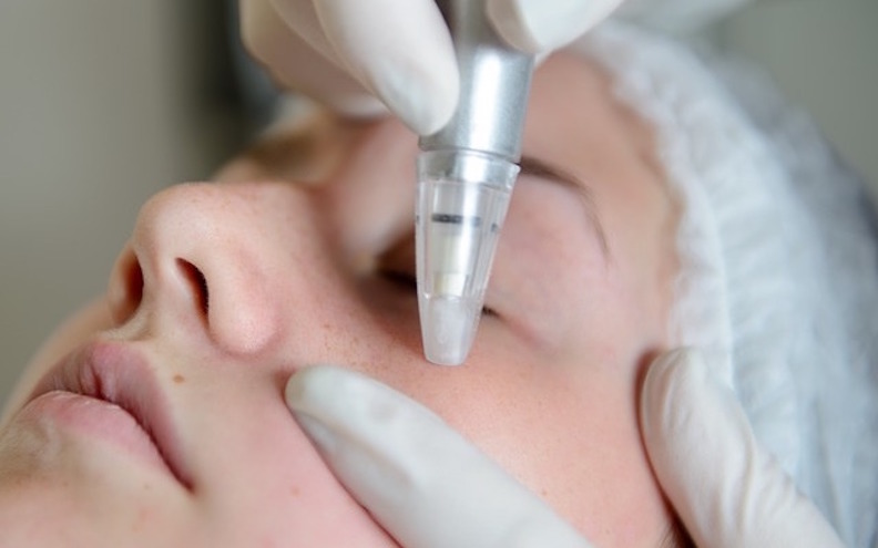 Microdermabrasion