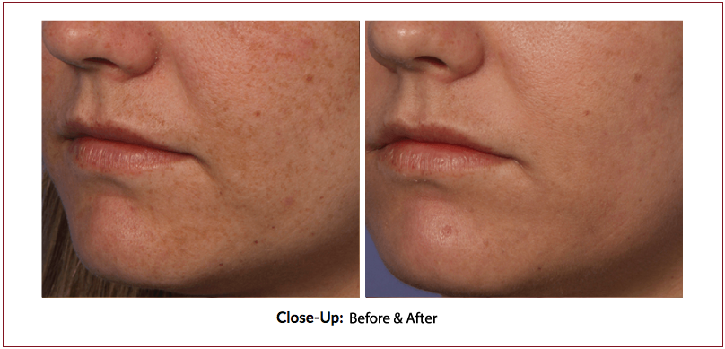 fraxel-before-after Fraxel Laser Eye Treatment