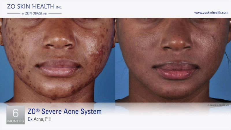 Acne Before and After